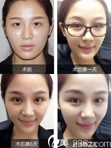 林平醫(yī)生雙眼皮案例圖 林平醫(yī)生雙眼皮案例圖