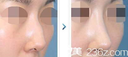 彭利濤鼻部整形案例 彭利濤鼻部整形案例