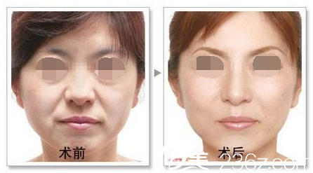 肖慶彥面部年輕化整形案例 肖慶彥面部年輕化整形案例