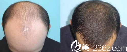 楊杰毛發(fā)移植整形案例 楊杰毛發(fā)移植整形案例