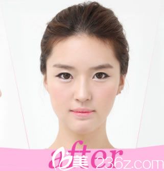 崔慧妍女士分享在韓國BK整形實現(xiàn)模特夢想的真實經(jīng)歷