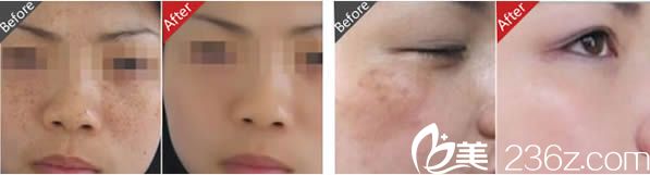 趙堅鋼祛斑案例圖 趙堅鋼祛斑案例圖