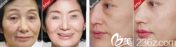 趙堅鋼院長塑美極治療效果圖 趙堅鋼院長塑美極治療效果圖