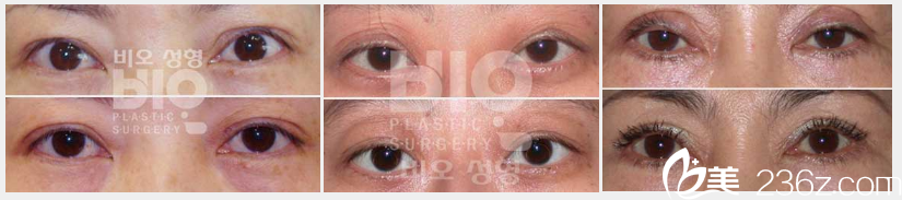 曹仁昌雙眼皮失敗修復(fù)案例對(duì)比圖 曹仁昌雙眼皮失敗修復(fù)案例對(duì)比圖
