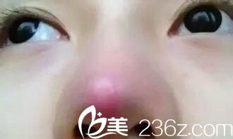 手術(shù)后鼻子為什么會(huì)發(fā)紅
