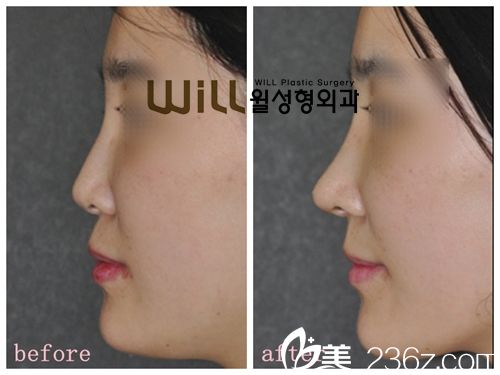 韓國(guó)will醫(yī)院隆鼻真人案例
