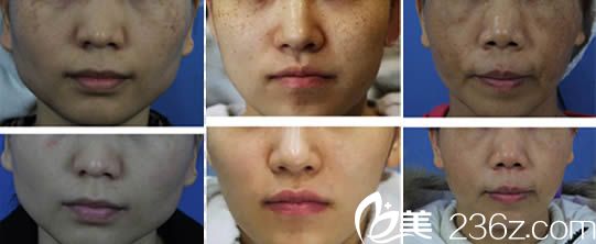 林秋蓉醫(yī)生激光祛斑案例 林秋蓉醫(yī)生激光祛斑案例