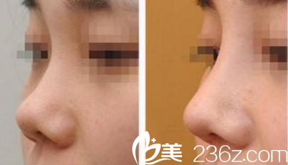 <!--<i data=20240703-sp></i>-->醫(yī)生達拉斯綜合隆鼻案例