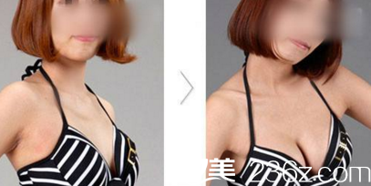 <!--<i data=20240703-sp></i>-->動感豐胸案例