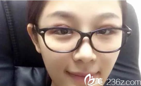 做完雙眼皮術(shù)后天的樣子 做完雙眼皮術(shù)后天的樣子