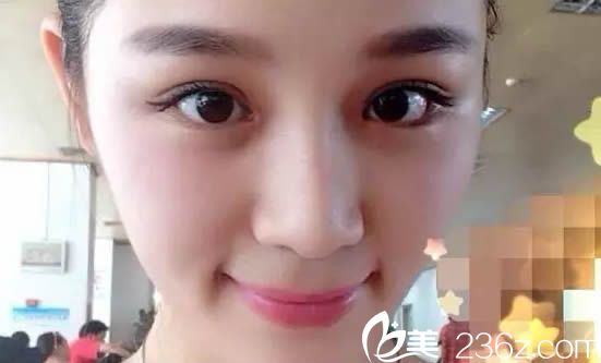 林平雙眼皮術(shù)后15天恢復(fù)效果 林平雙眼皮術(shù)后15天恢復(fù)效果