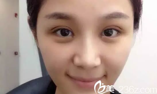 雙眼皮術(shù)后第6天拆完線的美照 雙眼皮術(shù)后第6天拆完線的美照