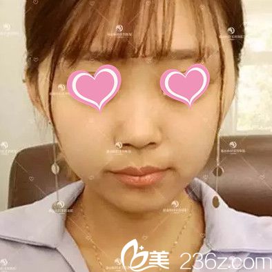 術(shù)前短下巴的我 術(shù)前短下巴的我