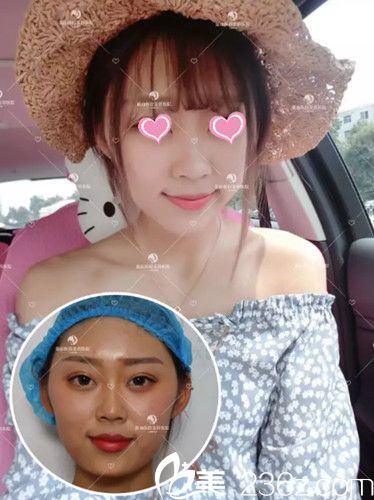 術(shù)后第2天下巴前后對(duì)比 術(shù)后第2天下巴前后對(duì)比