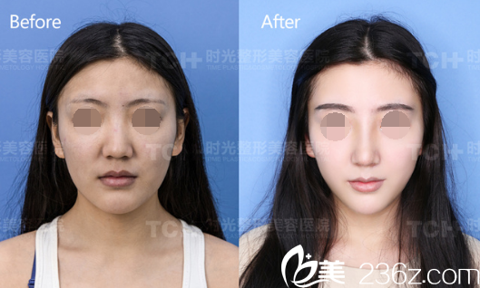 重慶時(shí)光DBM生態(tài)美弧鼻對(duì)比圖