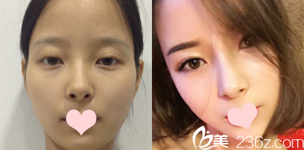 深圳美萊郭杰全面部自體脂肪填充<span style= 深圳美萊郭杰全面部自體脂肪填充<span style=