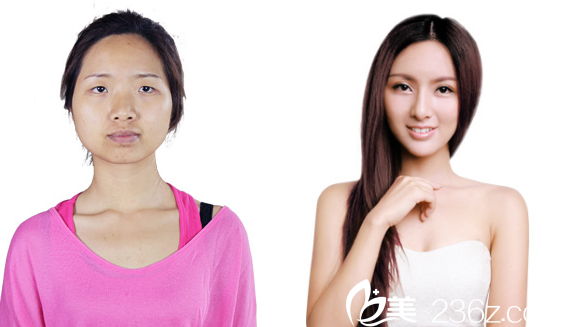 深圳美萊梁曉健隆鼻前后對比圖 深圳美萊梁曉健隆鼻前后對比圖