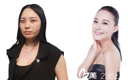 深圳美萊梁曉健主任隆鼻案例 深圳美萊梁曉健主任隆鼻案例