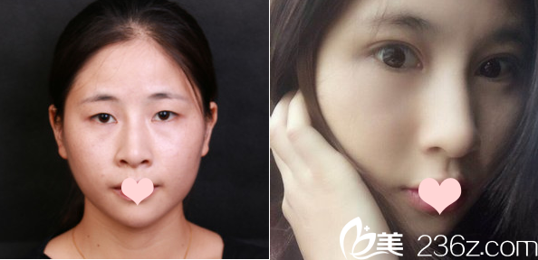 深圳美萊梁志為雙眼皮案例之開內(nèi)眼角