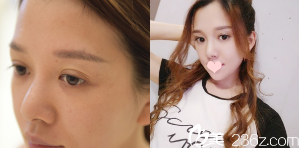 深圳美萊梁志為切開雙眼皮案例