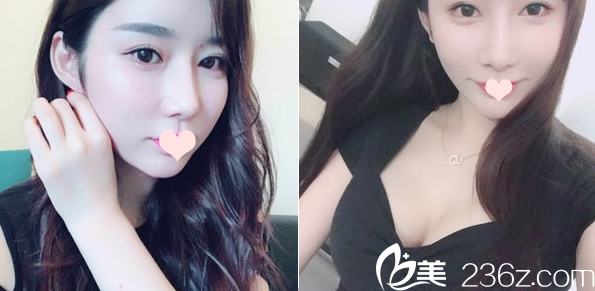 廣州紫馨鼻綜合+隆胸案例