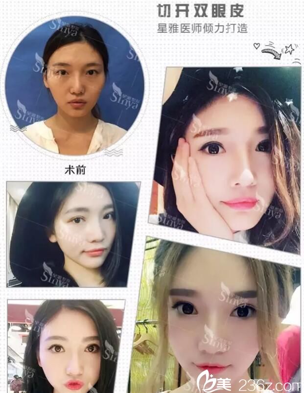 長沙星雅整形雙眼皮真人案例
