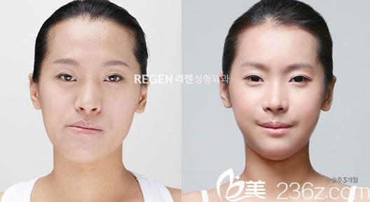 吳銘埈兩鄂手術(shù)前后效果對比 吳銘埈兩鄂手術(shù)前后效果對比