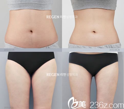 柳志翰院長的吸脂案例圖 柳志翰院長的吸脂案例圖