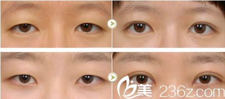 羅德豐院長雙眼皮案例 羅德豐院長雙眼皮案例