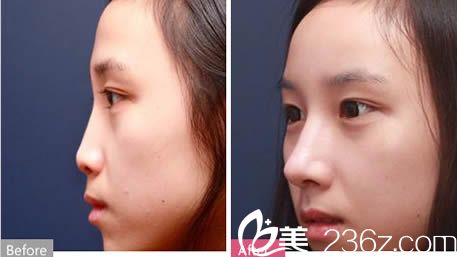 羅德豐假體隆鼻案例效果圖 羅德豐假體隆鼻案例效果圖