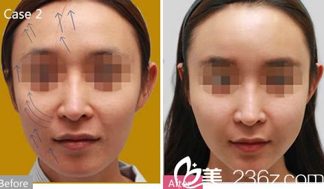 羅德豐醫(yī)生面部精雕前后對比圖 羅德豐醫(yī)生面部精雕前后對比圖