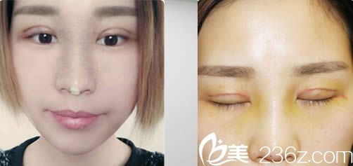 雙眼皮術(shù)后第3天和拆線后的樣子 雙眼皮術(shù)后第3天和拆線后的樣子