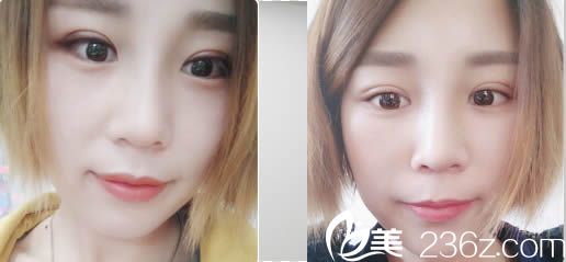 羅德豐鼻綜合案例效果圖 羅德豐鼻綜合案例效果圖