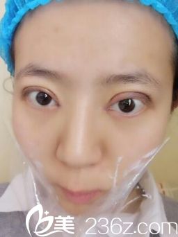 西安同安濟(jì)醫(yī)院雙眼皮手術(shù)恢復(fù)后第七天 西安同安濟(jì)醫(yī)院雙眼皮手術(shù)恢復(fù)后第七天