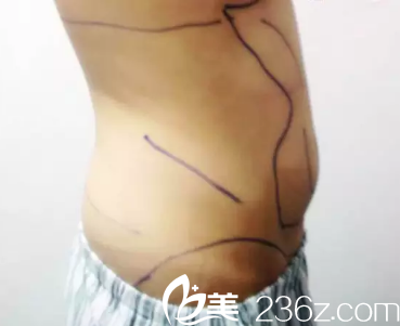 王家林醫(yī)生為我術(shù)前畫線