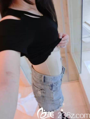 做完吸脂后10天的樣子