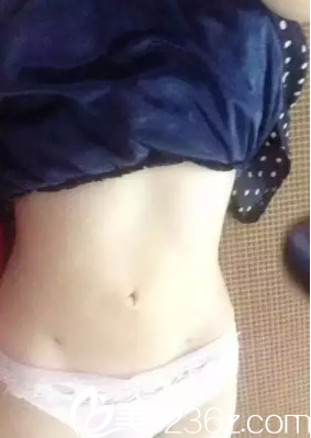 做腰腹吸脂15天已經(jīng)瘦好多