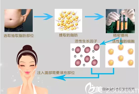 自體脂肪提取填充方式