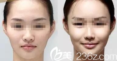 自體脂肪豐蘋果肌