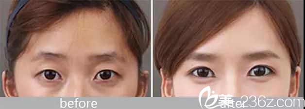 自體脂肪豐臥蠶