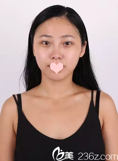 隆鼻術前照片 隆鼻術前照片