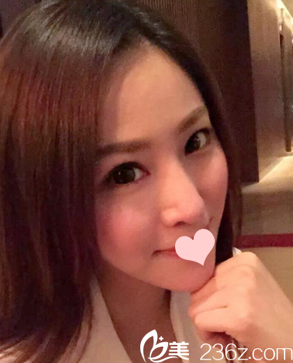 找羅志敏醫(yī)生做完鼻綜合術后37天自拍 找羅志敏醫(yī)生做完鼻綜合術后37天自拍