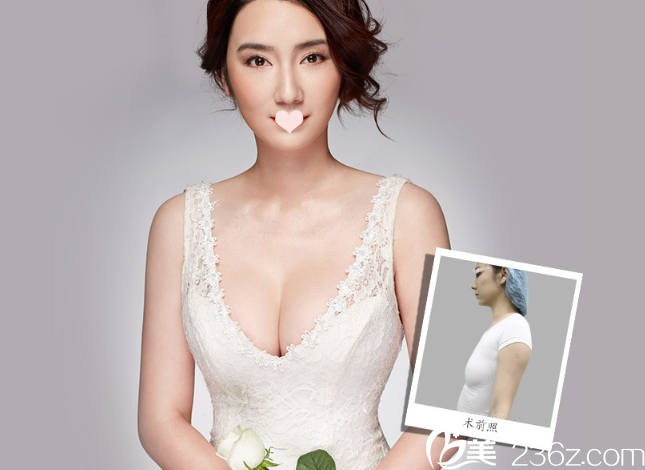 李映雨隆胸案例分享 李映雨隆胸案例分享