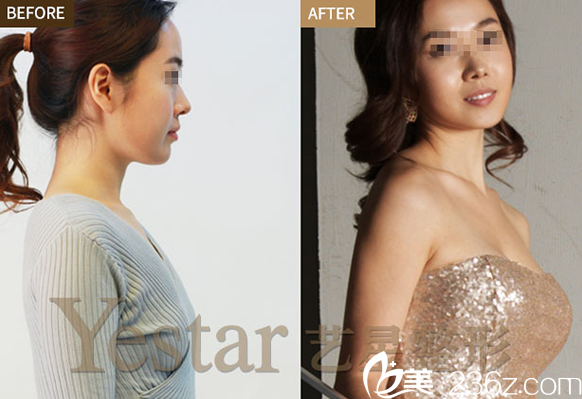 劉曉榮假體隆胸案例對(duì)比 劉曉榮假體隆胸案例對(duì)比