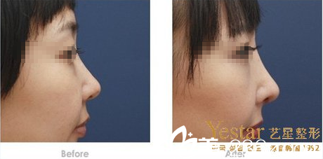 周順波隆鼻手術(shù)側(cè)面效果對(duì)比圖