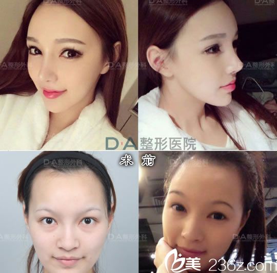 孫豪成院長的鼻部整形案例