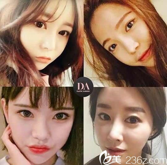 孫豪成院長做眼整形案例圖