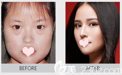 整形醫(yī)院李鵬祛眼袋案例