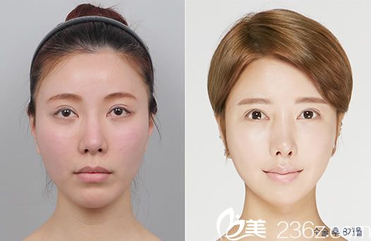 閔丙伊院長的皮膚美容案例