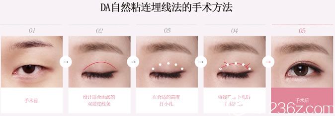 DA埋線雙眼皮手術(shù)過程示意圖 DA埋線雙眼皮手術(shù)過程示意圖